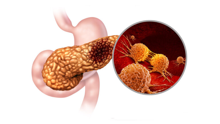 Global Pancreatic Cancer Industry 