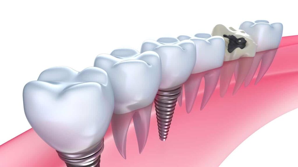 Global Peri-implantitis Treatment Industry