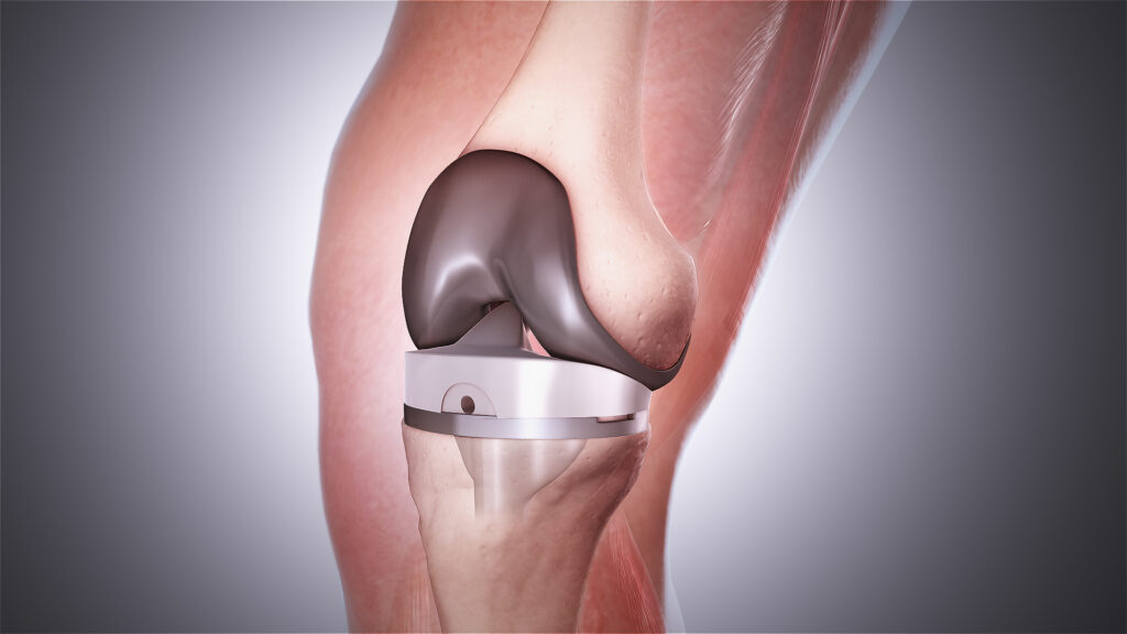 Knee Reconstruction Devices