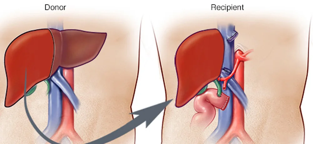 Liver Transplant Market