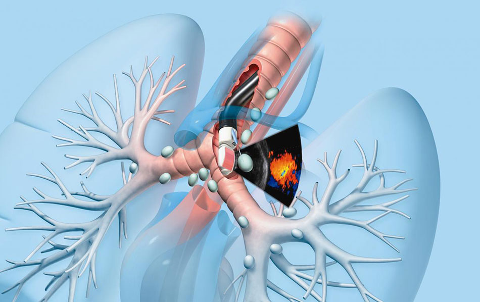 Lung Biopsy Systems Market