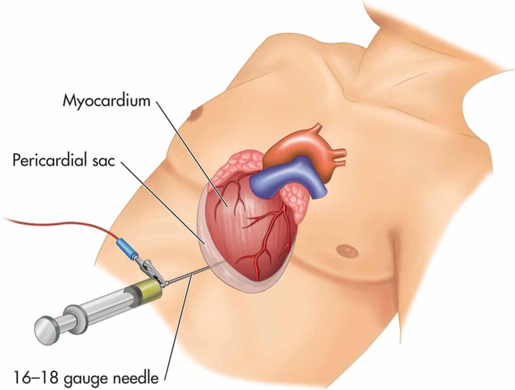 Pericarditis Treatment Market