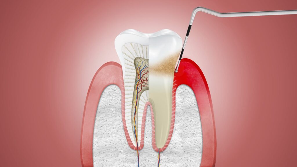 Periodontal Market