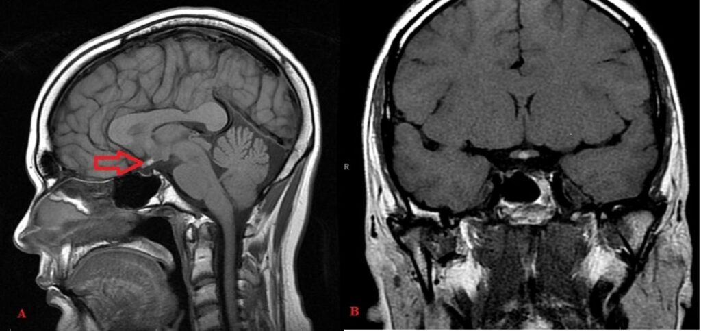 Pituitary Stalk Interruption Syndrome Treatment Market