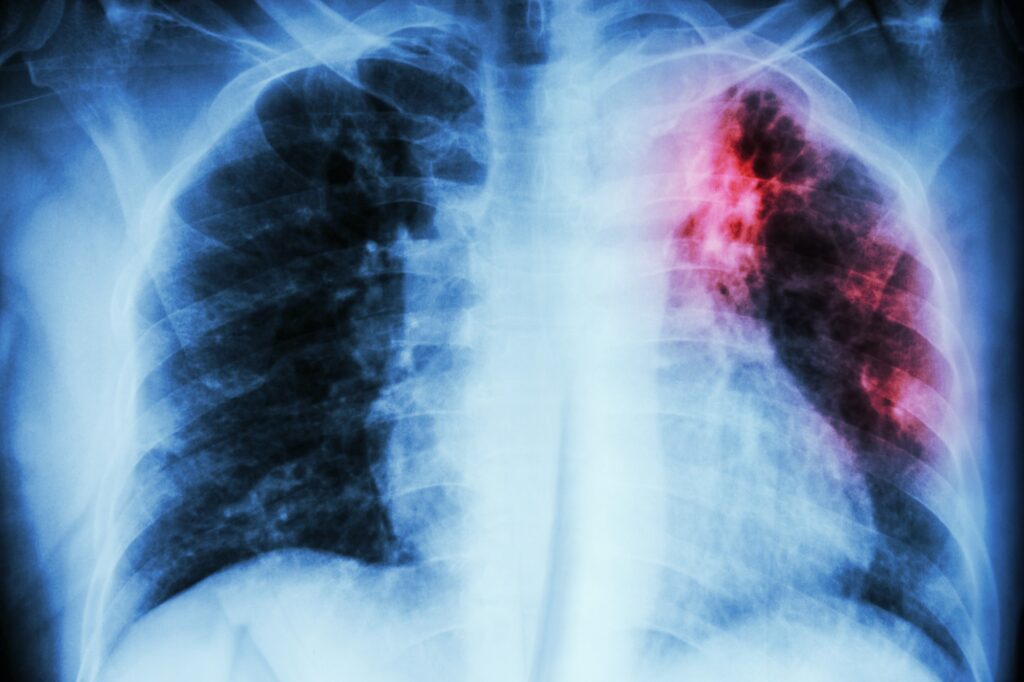 Pulmonary Fibrosis Biomarker