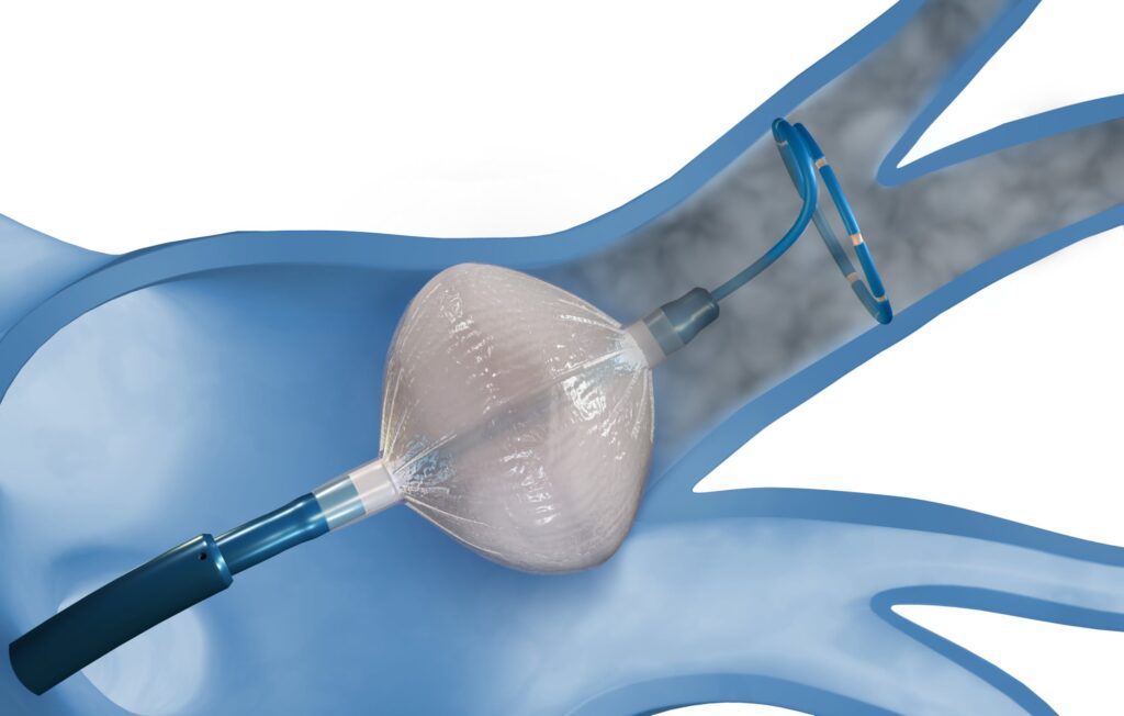 Radiofrequency Balloon Catheter Market