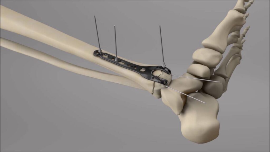 Rib Fracture Repair Systems Market