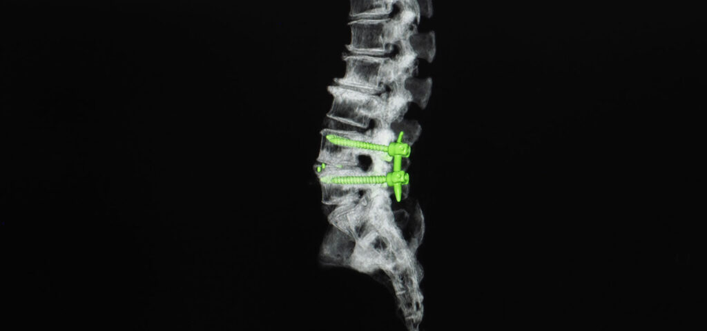 Spinal Fusion Market