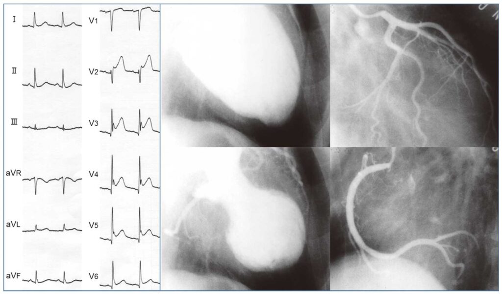 Takotsubo Syndrome Therapeutics Market