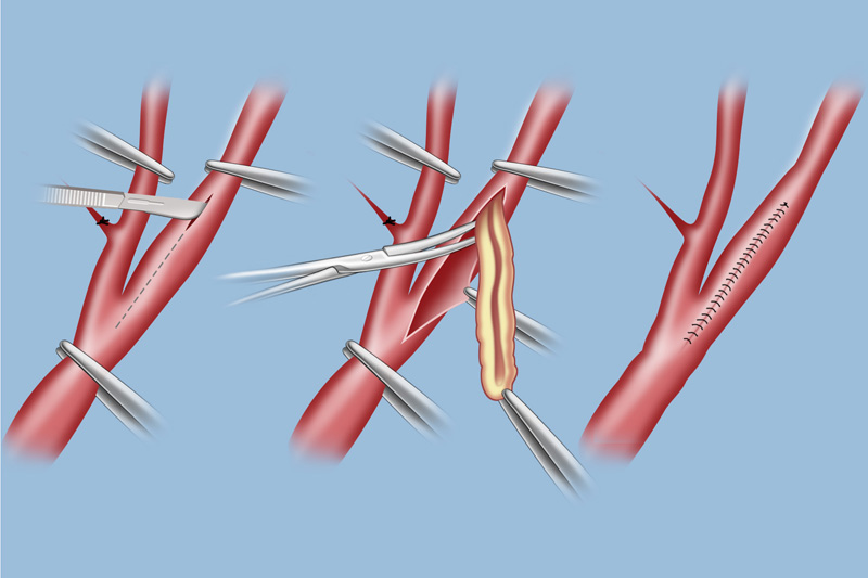 Vascular Patches Market