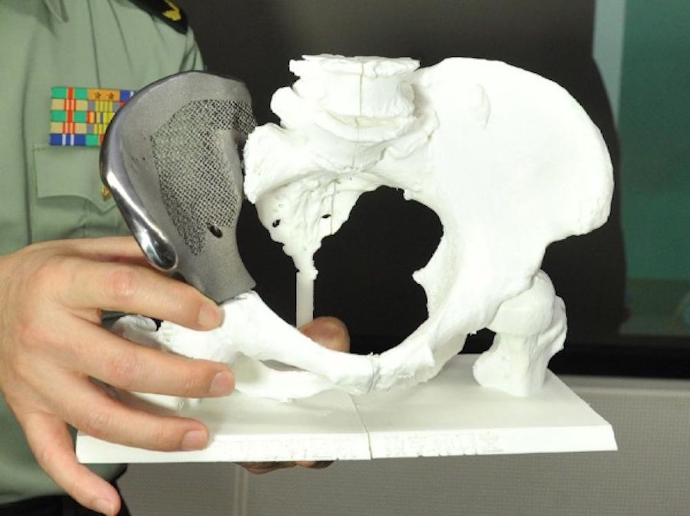 3D Printed Maxillofacial Implants Market