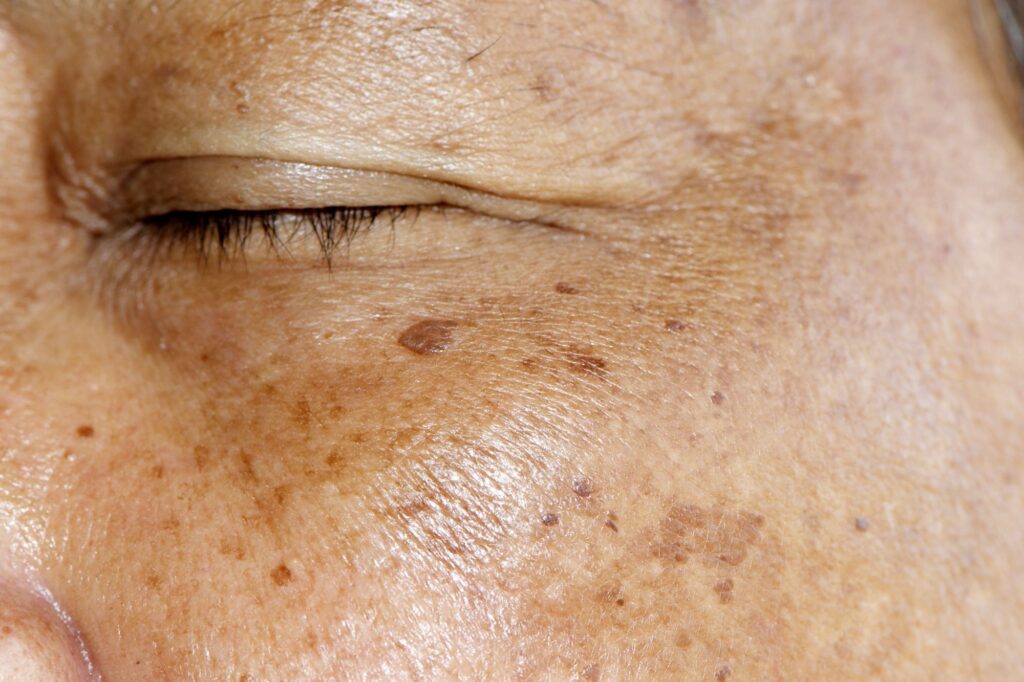 Actinic Keratosis Treatment Market