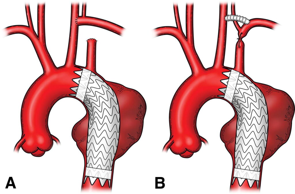 Aortic Stents Grafts Market