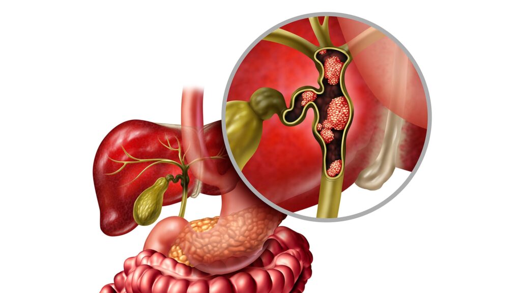 Biliary Tract Cancers Treatment Market