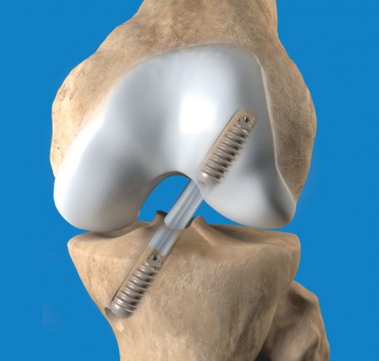 Bone Screw System Market