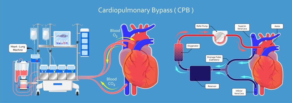 Cardiopulmonary Bypass System