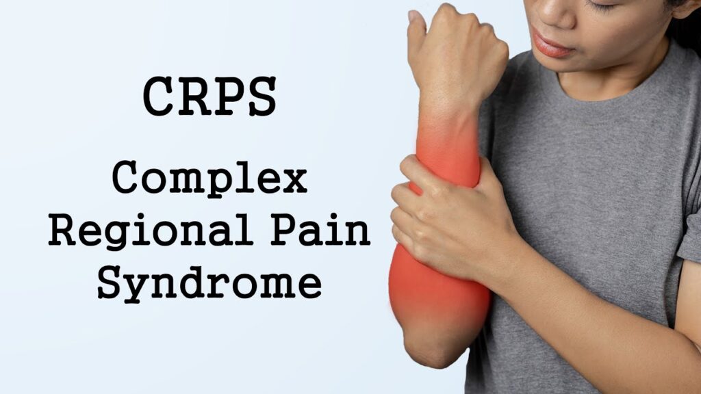 Complex Regional Pain Syndrome