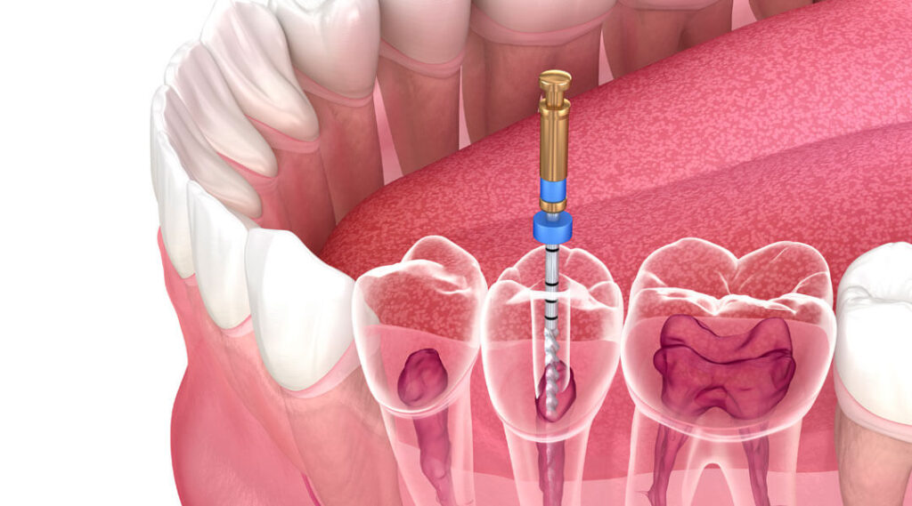 Dental Caries and Endodontic Market