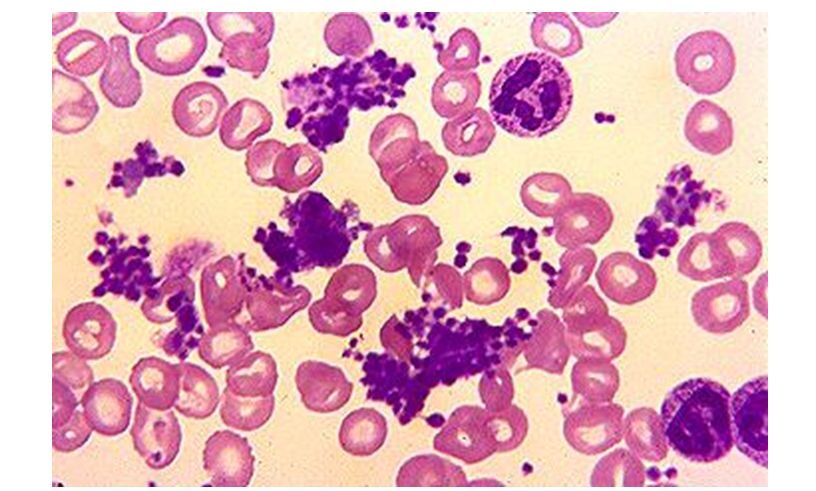 Essential Thrombocythemia Market