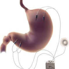 Gastric Electrical Stimulator