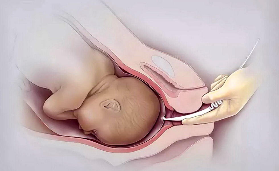 Amniotic Membrane Market