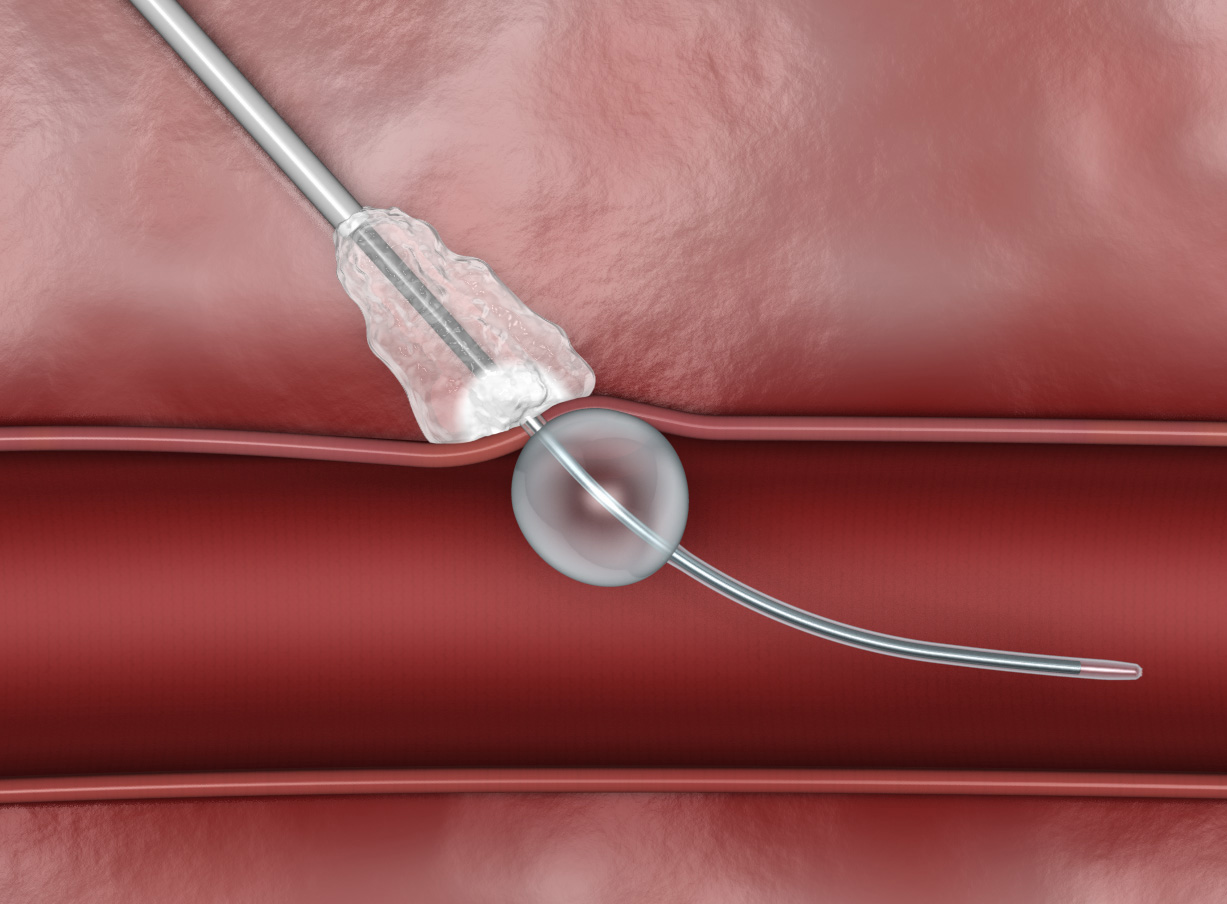 Vascular Closure Devices Market Poised for Significant Growth ...