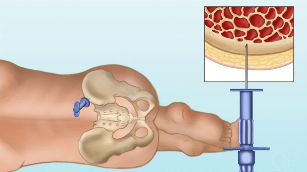 Graft Versus Host Disease (GvHD) Treatment