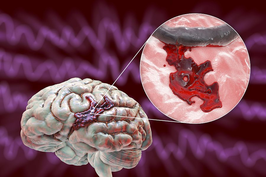 Haemorrhage Control Systems Market