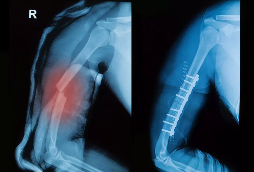 Humeral Implants