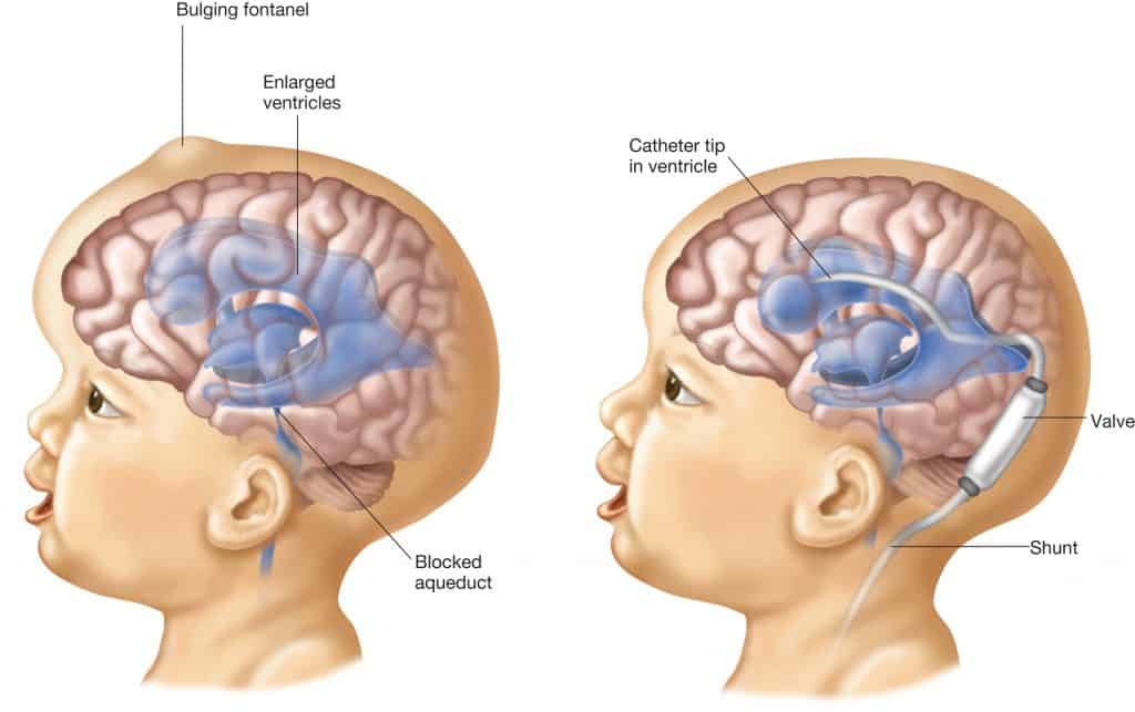 Hydrocephalus Shunt Market