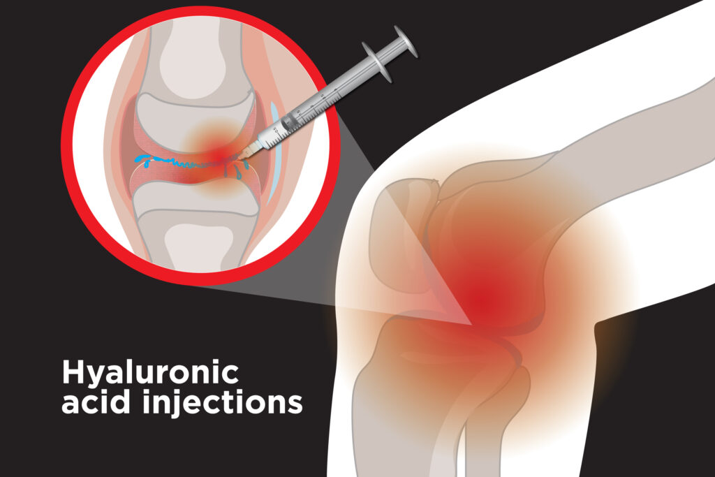 Knee Hyaluronic Acid Injections Market