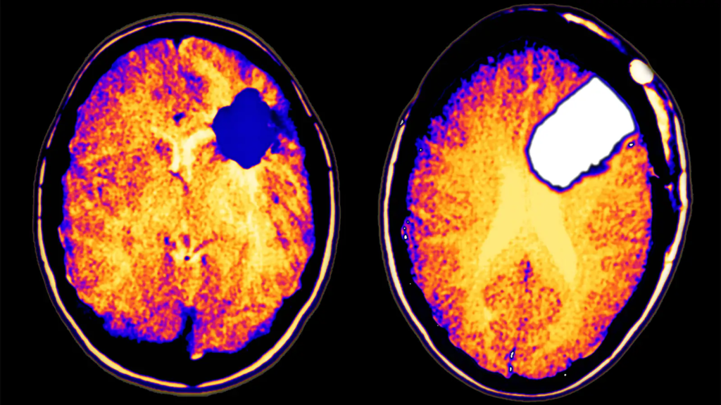 Low-Grade Glioma Therapeutics Market