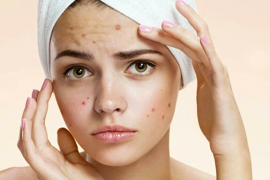 Moderate-to-Severe Acne Treatment Market