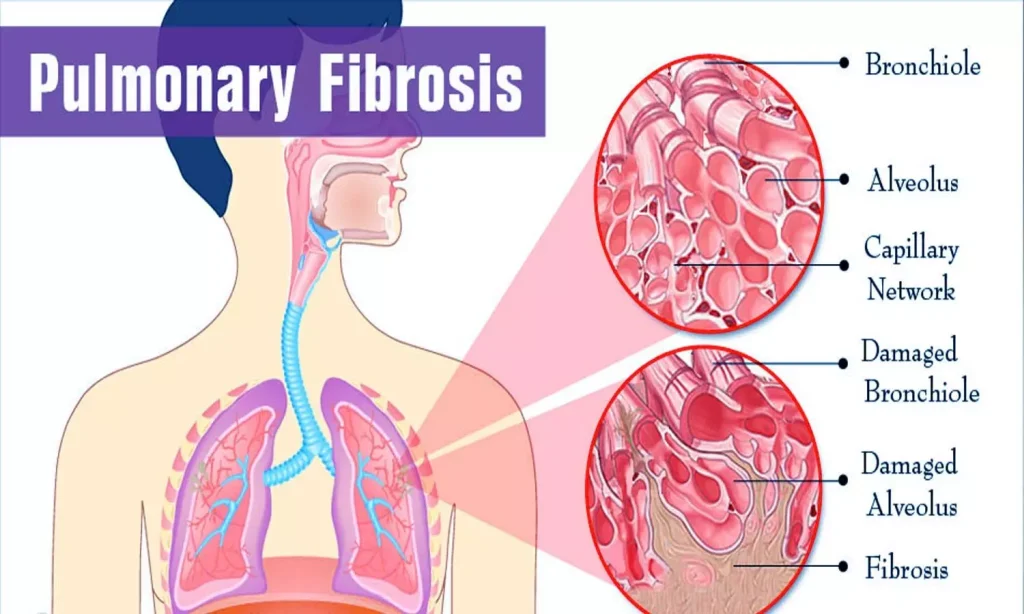 Pulmonary Fibrosis Biomarker