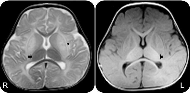 Sandhoff Disease Therapeutics Market