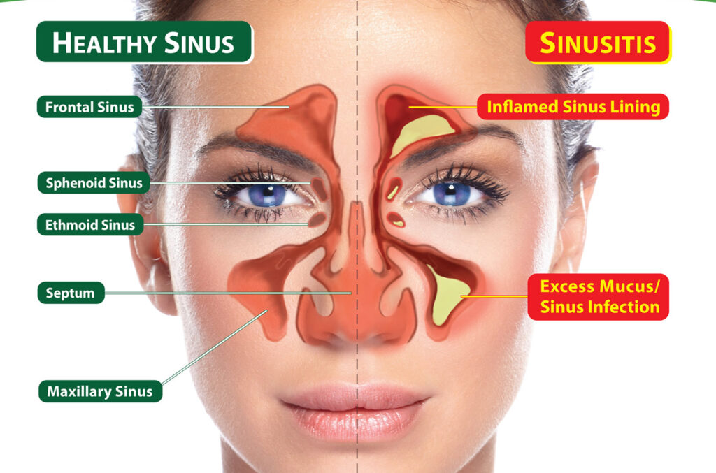 Sinus Therapeutic Drugs Market
