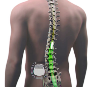 Spinal Cord Stimulators Market