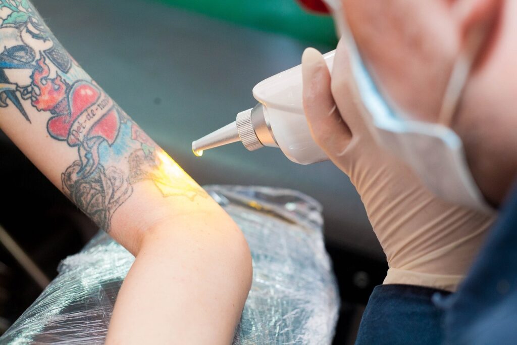 Tattoo Removal Laser Market