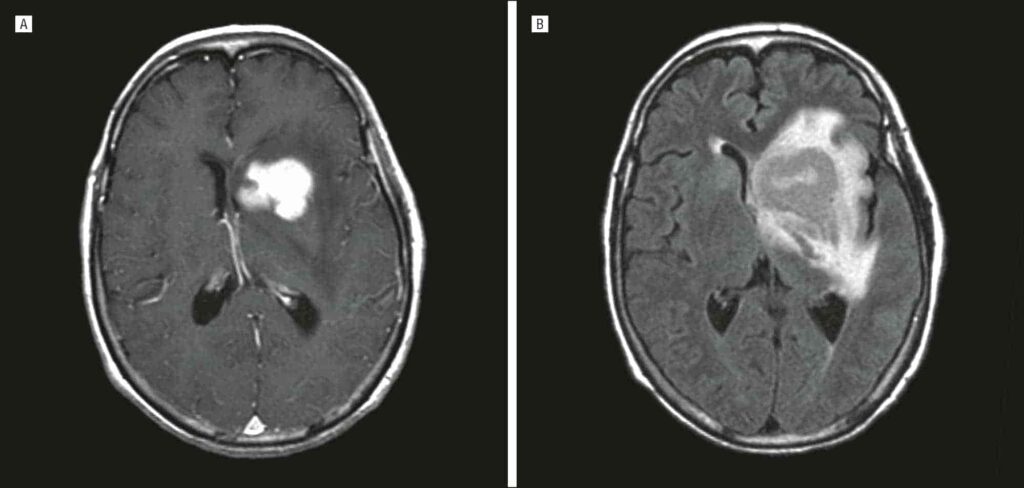 AIDS-Related Primary CNS Lymphoma Market