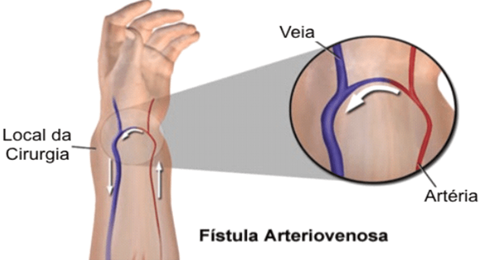 Arteriovenous Fistula Treatment Market