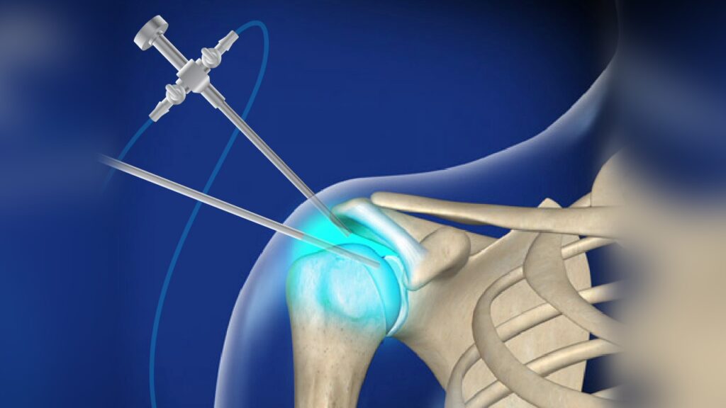 Arthroscopy Devices Market