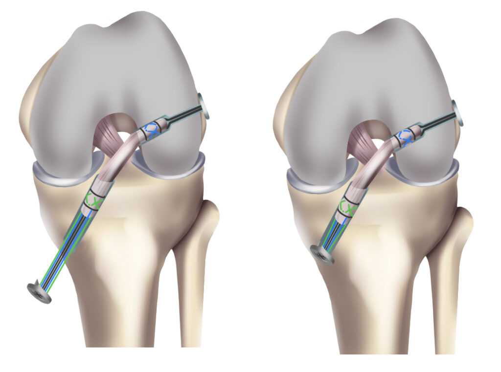 Bone Graft Fixation System Market