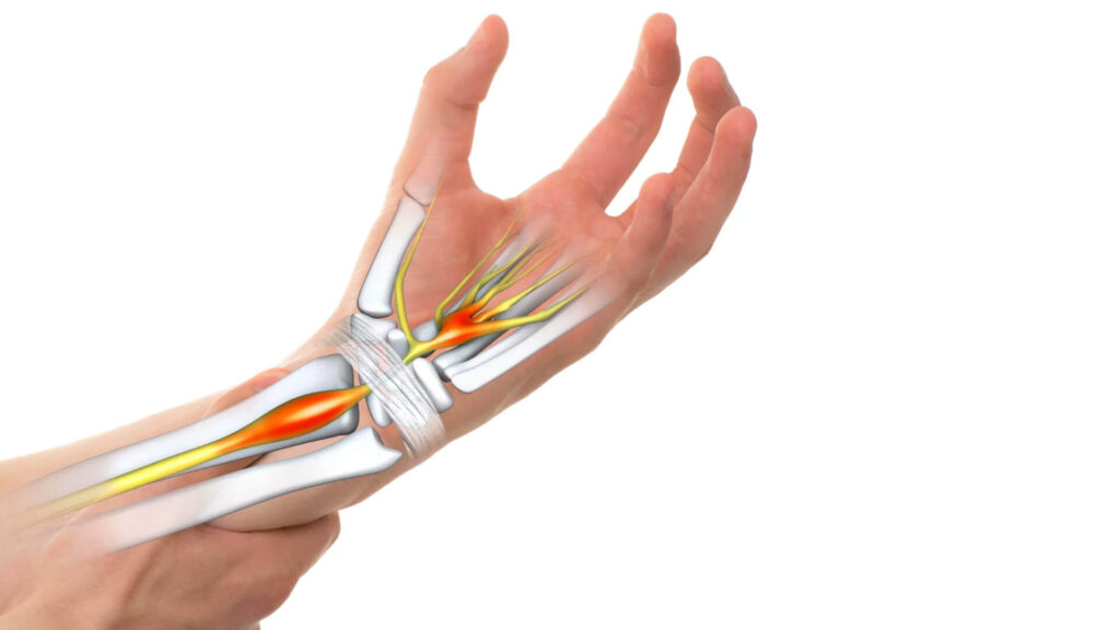 Global Carpal Tunnel Release System Market