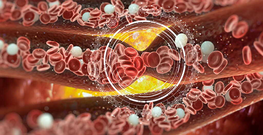 Catheter-Directed Thrombolysis Market