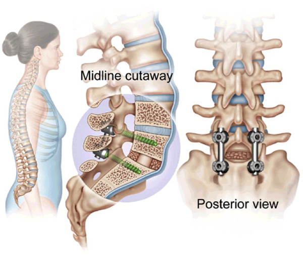 China Spinal Fusion Market