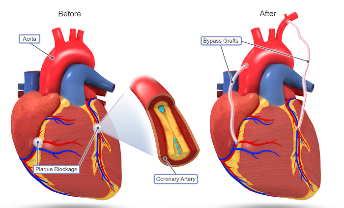 Coronary Artery Bypass Graft Market