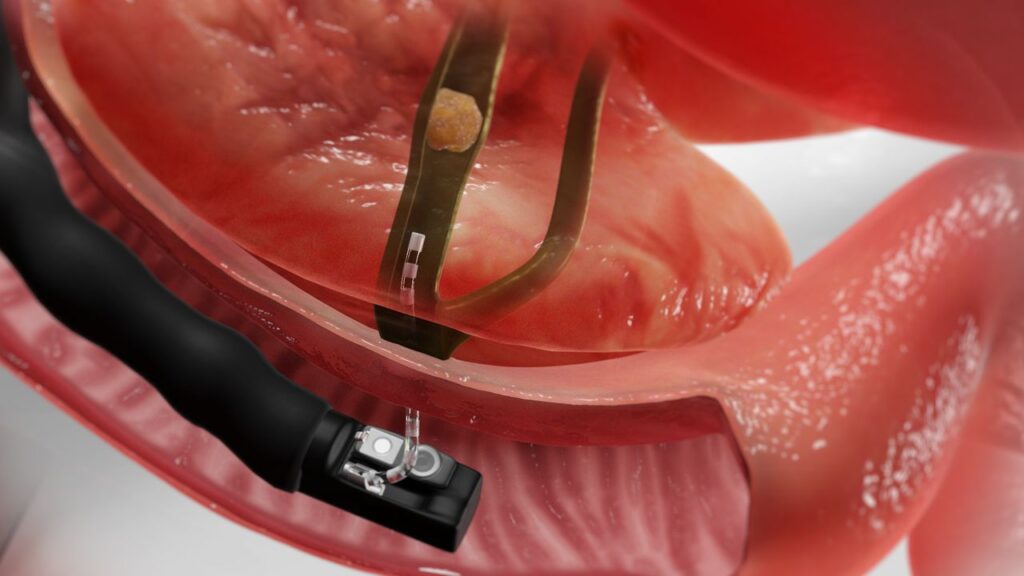 Endoscopic Retrograde Cholangiopancreatography (ERCP) Devices Market