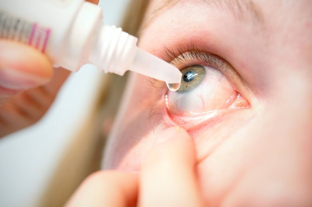 Epidemic Keratoconjunctivitis Treatment Market