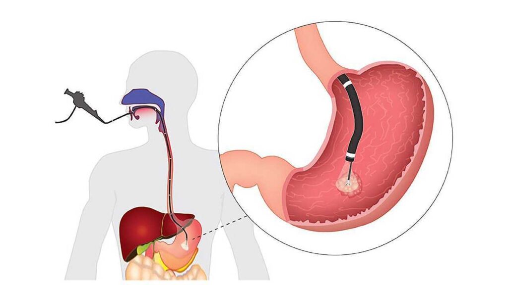 Gastric Space-Occupying Devices Market