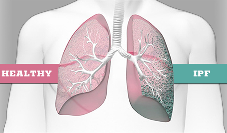 Idiopathic Pulmonary Fibrosis Management Market